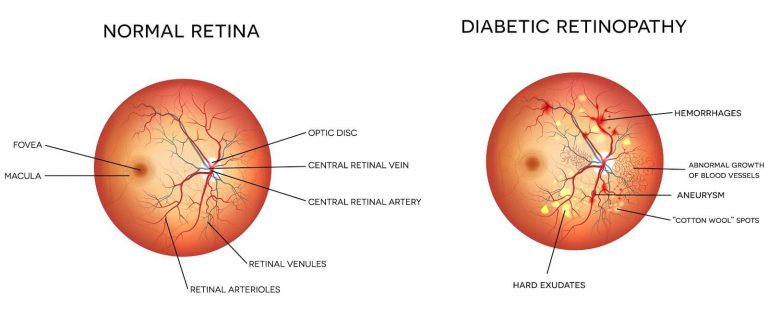 diabetic retinopathy in retina