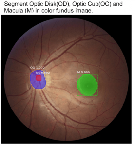 Diabetic retinopathy localised detection